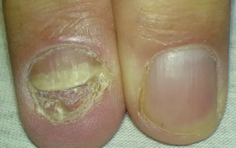 Exofeet oil